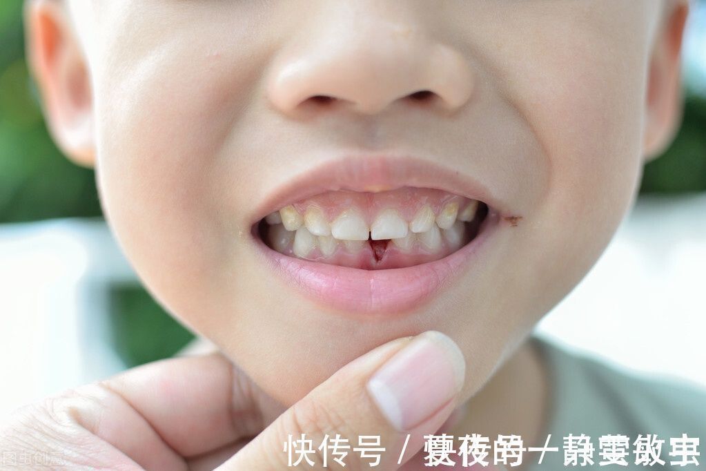 牙齿|孩子长出“双排牙”太难看?是乳牙脱落太晚导致的,需要适当刺激