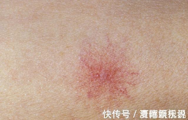 病变|肝脏变硬,头部先知医生头部若有3个表现,或提示该养肝了