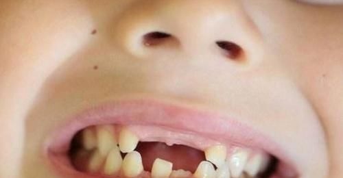 脱落|孩子“乳牙”脱落别着急扔,关键时刻能救命不懂为啥尽快了解下