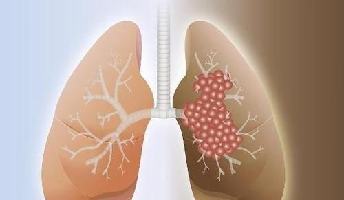 肺部|肺不好的人,牢记3个养肺“小妙招”,可能对养肺护肺有帮助!