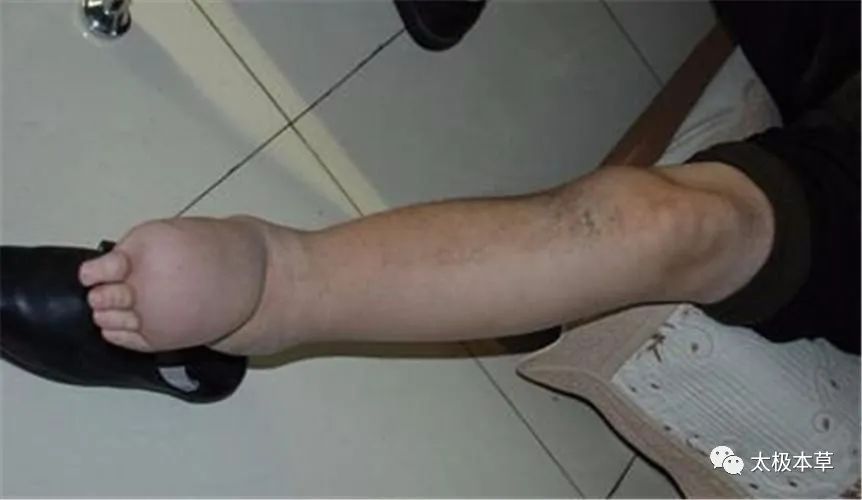 欧阳|类风湿关节炎与舒筋草的故事