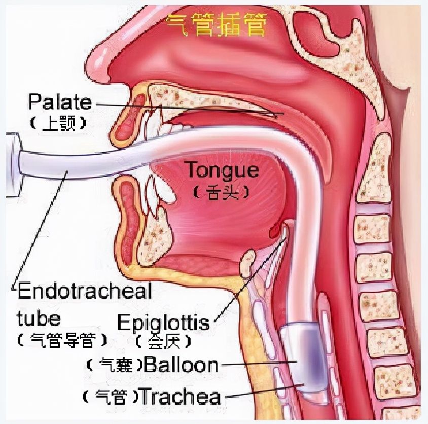 手术|手术后咽干喉咙痛是麻醉造成的吗？