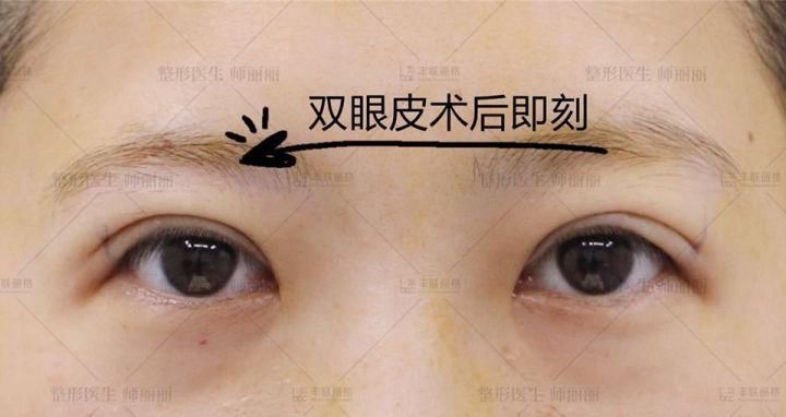 眼睛|双眼皮修复手术可以让眼睛变回初眼的样子吗?