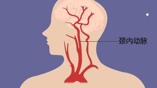 堵塞|颈动脉如果被堵塞了,哪个部位反应最强烈?看完或许有帮助