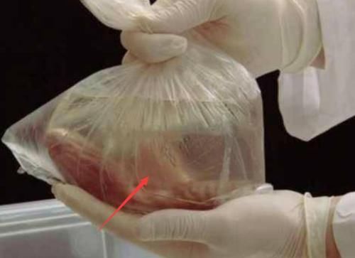 截肢|在医院做完截肢手术以后,医院会怎么处理“断肢”呢说了你可能不信