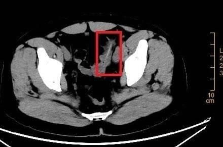  男子腹痛4个月后取出6厘米牙签，医生：这个习惯不可取！