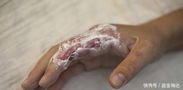 土方子|如果宝宝烫伤了宝妈们不要急,进来看看我教你!