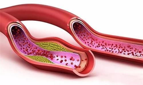 服用降压药|高血压补叶酸,吃多长时间合适?同型半胱氨酸高,多长时间复查?