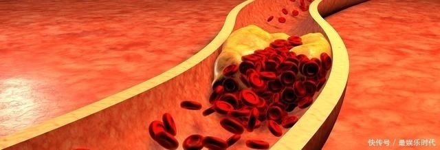 中风史|高血脂是伤肾的“洪水猛兽”，这3大误区要改掉，有助于降血脂