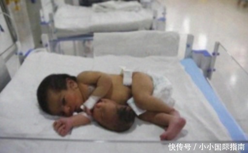 畸形|刚出生的双婴儿“第二个宝宝头颅”长在肚子上,心疼妈妈跟宝宝