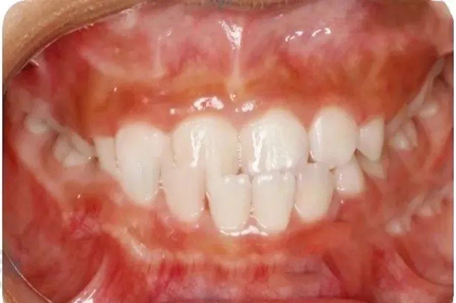 牙齿|不吃糖,孩子却满口烂牙!罪魁祸首竟是它,快看你家有没有