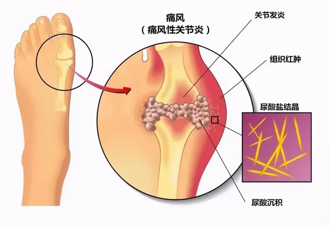 成都西部痛风风湿医院|成都西部痛风风湿医院：只有降尿酸药物才能治痛风吗？