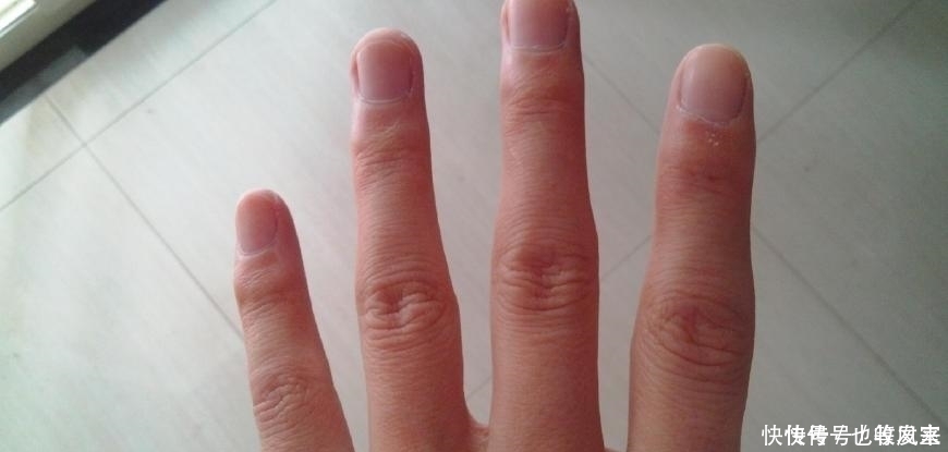 肝好的人，手上可能有3个“记号”，若发现一个，恭喜，肝较健康