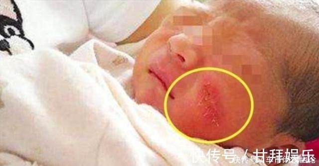 恢复期|剖腹产划伤宝宝脸颊,医生安慰“问题不大”,2个月后父母找说法