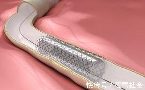 冠心病|冠心病放了支架，能不能做核磁？2007年之后放支架的人需注意