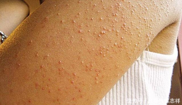 买了裙子，但是鸡皮还没解决！有啥办法缓解鸡皮肤？