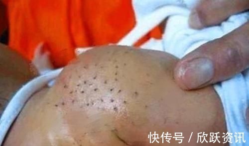 绞痛|宝宝身上出“黑刺”,妈妈全部拔掉后宝宝发烧,医生怒斥宝妈无知