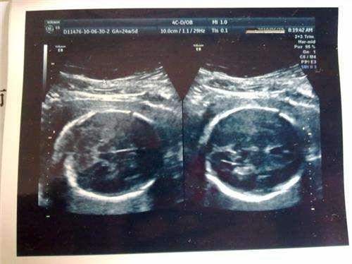 科普：胎儿大小与孕妈吃多少关系不大，决定因素是这5个