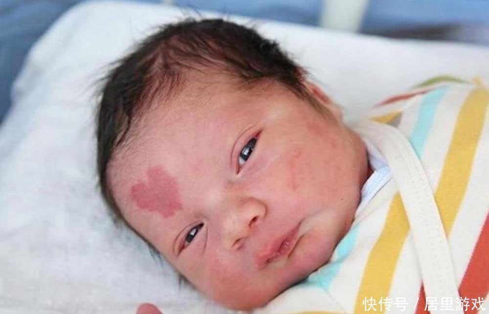 宝宝|宝宝为什么会长胎记？与孕期行为有关，孕妈怀孕后要克制自己