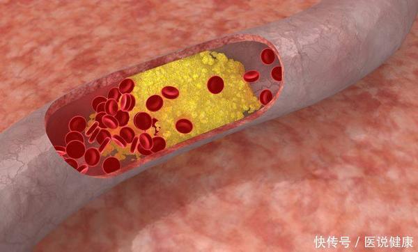 颧骨|男人衰老时，身体往往有“2高、2低、2硬”，若你有，注意保养