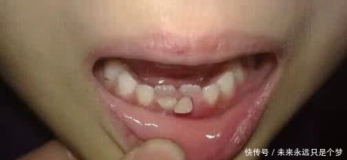 医生|6岁女儿长出双排牙能拔吗?医生说出原因后,妈妈:不该这样喂你