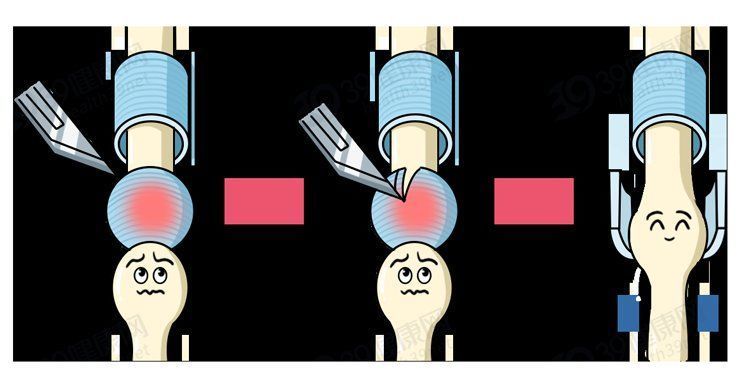 折磨|常年折磨女性的腱鞘炎，是怎么产生的？如何治疗？告诉你详细方法