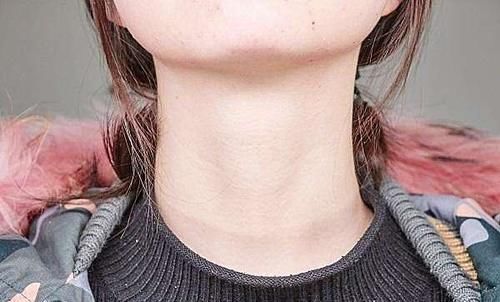 淋巴结肿大|淋巴结肿大不是淋巴癌的唯一症状,得了淋巴癌,还会有哪些异常