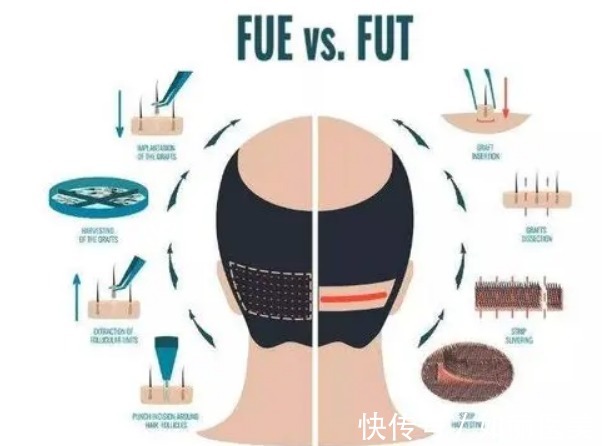 多方面 头顶植发大概需要多少个单位,多少钱?2022美发攻略教你!