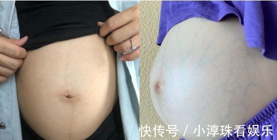 孕期|怀孕后害怕身上长妊娠纹,注意这些要点,让妊娠纹离得远远的