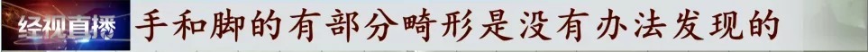 胎儿|宝宝出生缺失四根手指，家长质疑孕检误诊，涉事医院回复：不存在