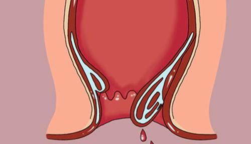 大便拉出血，是痔疮，还是直肠癌？医生：要学