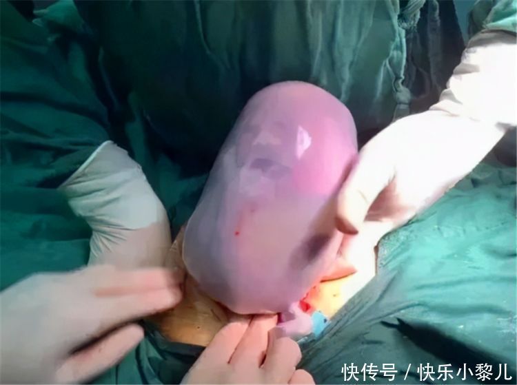 宝宝|90后宝妈生出“果冻宝宝”,陪产宝爸吓得脸发白,医生却说:恭喜