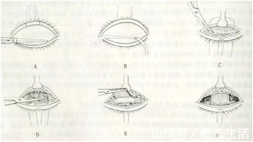 黑眼仁|上睑下垂眼无神，做个双眼皮手术就能搞定吗？