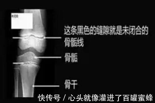 医生|8岁男孩长个太慢,医生诊断骨骺线疑似闭合,四个征兆一直被忽视