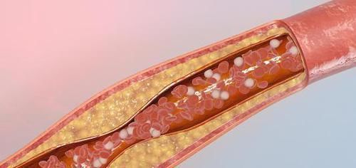 美国心脏协会|中国高血压人群这么多,到底是因为什么?其实多是一种饮食习惯