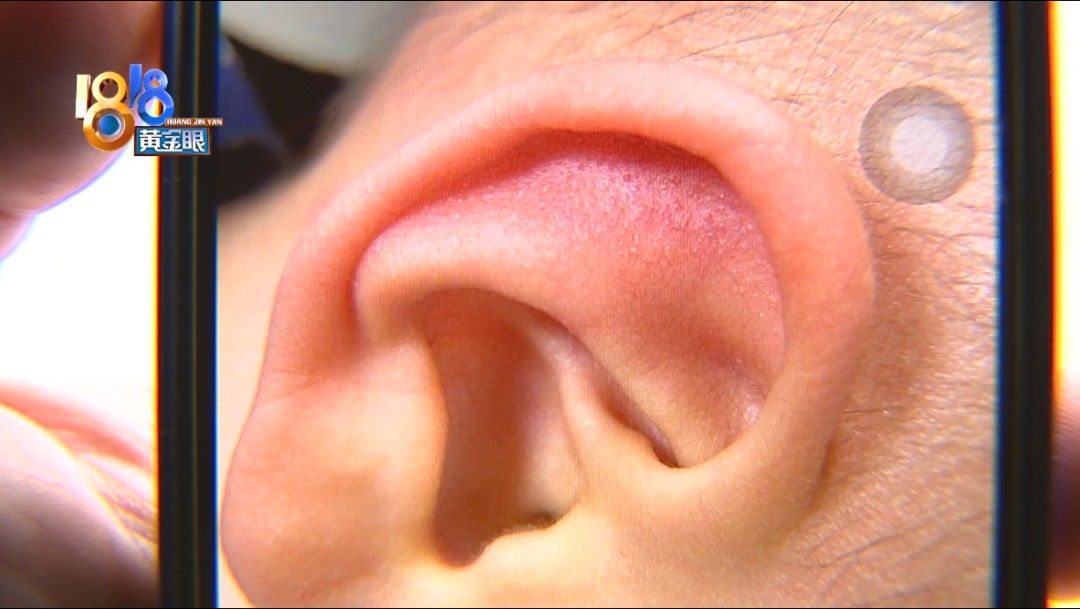 王女士|孩子身上爆发红疹，母亲怀疑泳池水质