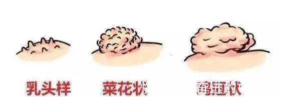 华西|成都中医肿瘤研究院(万年路2号):特邀华西退休团队会诊中医治皮肤瘤