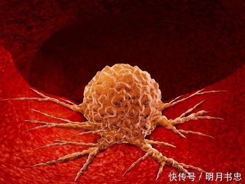 平滑肌瘤|良性肿瘤可以不用动手术?告诫:4类良性肿瘤“不好惹”