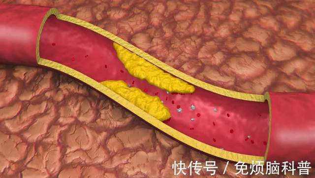 血液粘稠度|暴雨天,老人需警惕三种血管病,别做这三件事,更好远离疾病