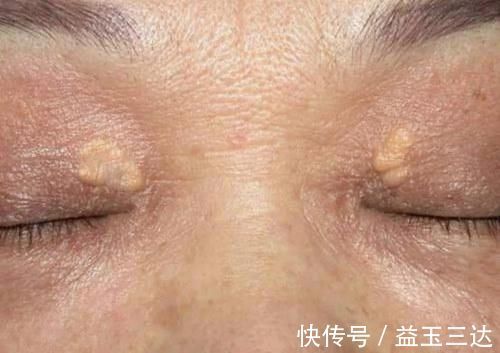 癌变|你的眼睑上有小黄瘤子吗？是不是血脂高的象征？营养师说出答案