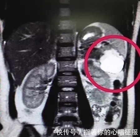 超声检查|做了多次B超检查还是没发现胎儿,医生详细检查后,不由大吃一惊