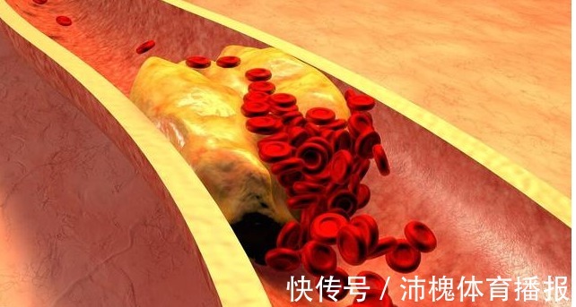 耳垂|血脂高不高,看头就知道,若没有4种症状,恭喜,血管还算通畅