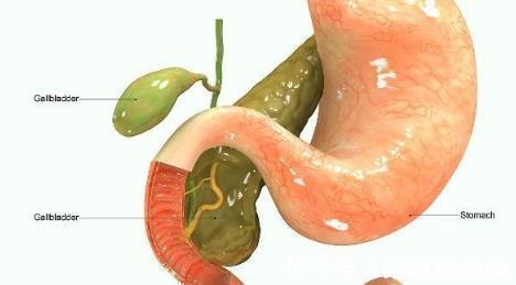 治疗|体内有“胆结石”的人,大多数有以下几个表现,切勿忽视