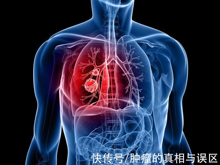 防治|发病率、死亡率第一！肺癌的2个防治关键，做好了或能提高生存率