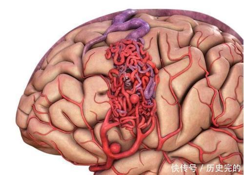 研究生突发头晕呕吐,一查竟是脑出血,患者没到竟离死亡这么近