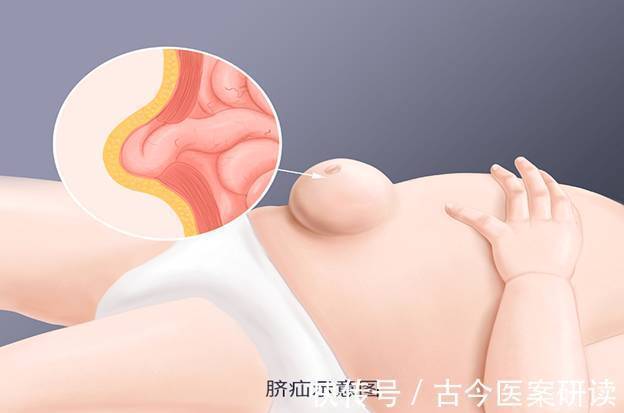 医生|小儿疝气是怎么一回事?医生:两种小儿疝气,家长要有所了解