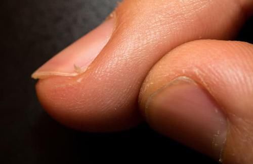 为什么有的人指甲旁总长 倒刺 3个原因占主导 快资讯