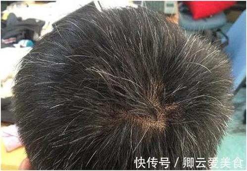補虛|治白發最好的方子，可緩解白發太多的問題，補虛又烏發，值得體會