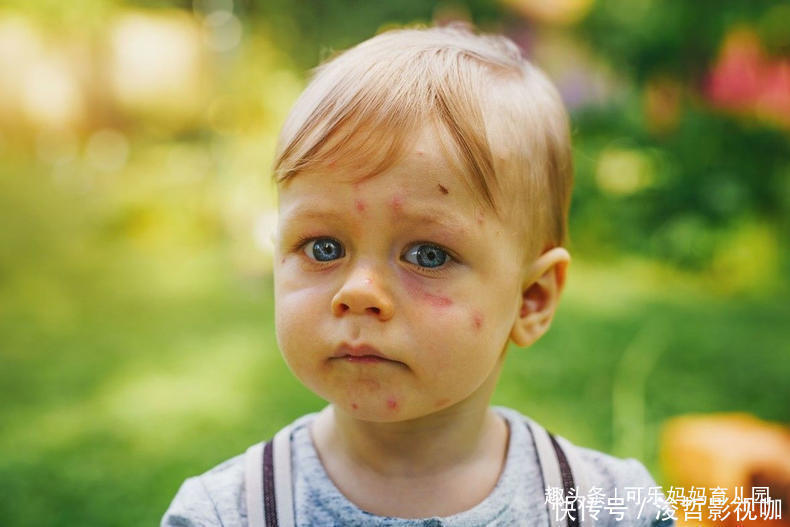 蚊虫|防蚊虫大作战，宝妈积极做好3步，宝宝肌肤免受伤害