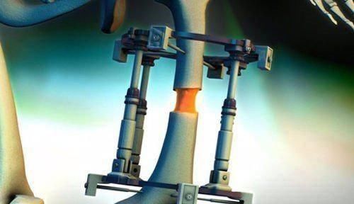 李亚诺|高三学生因身高矮小自卑,花16万断骨增高7.2厘米,如今怎样?